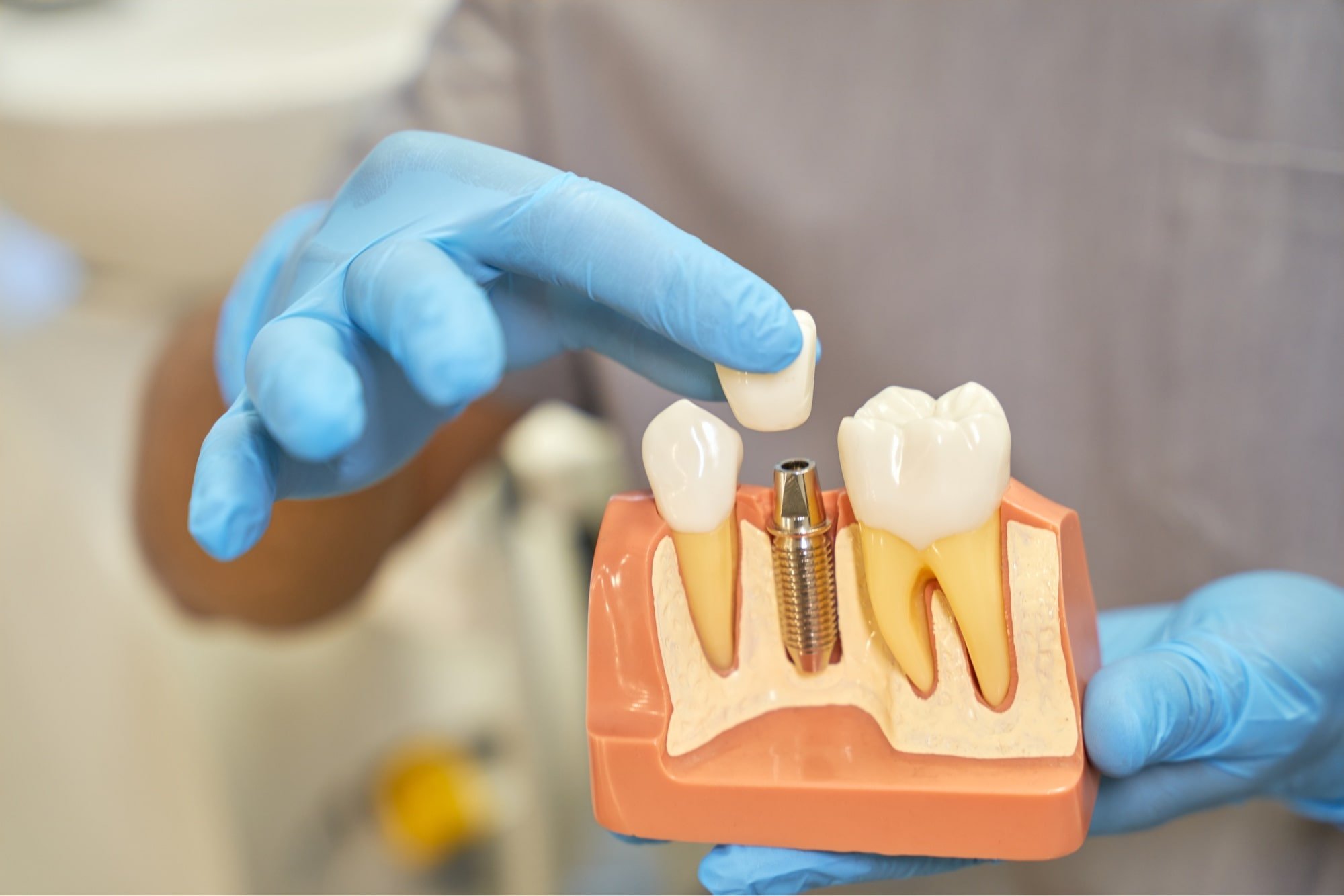 Find Affordable Dental Implants in Vancouver, WA Ranieu Family Dental