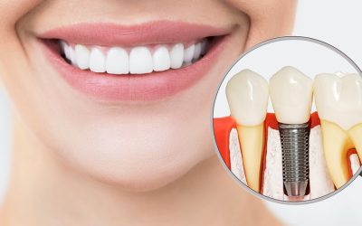 Can You Get a Dental Implant While Being Pregnant?